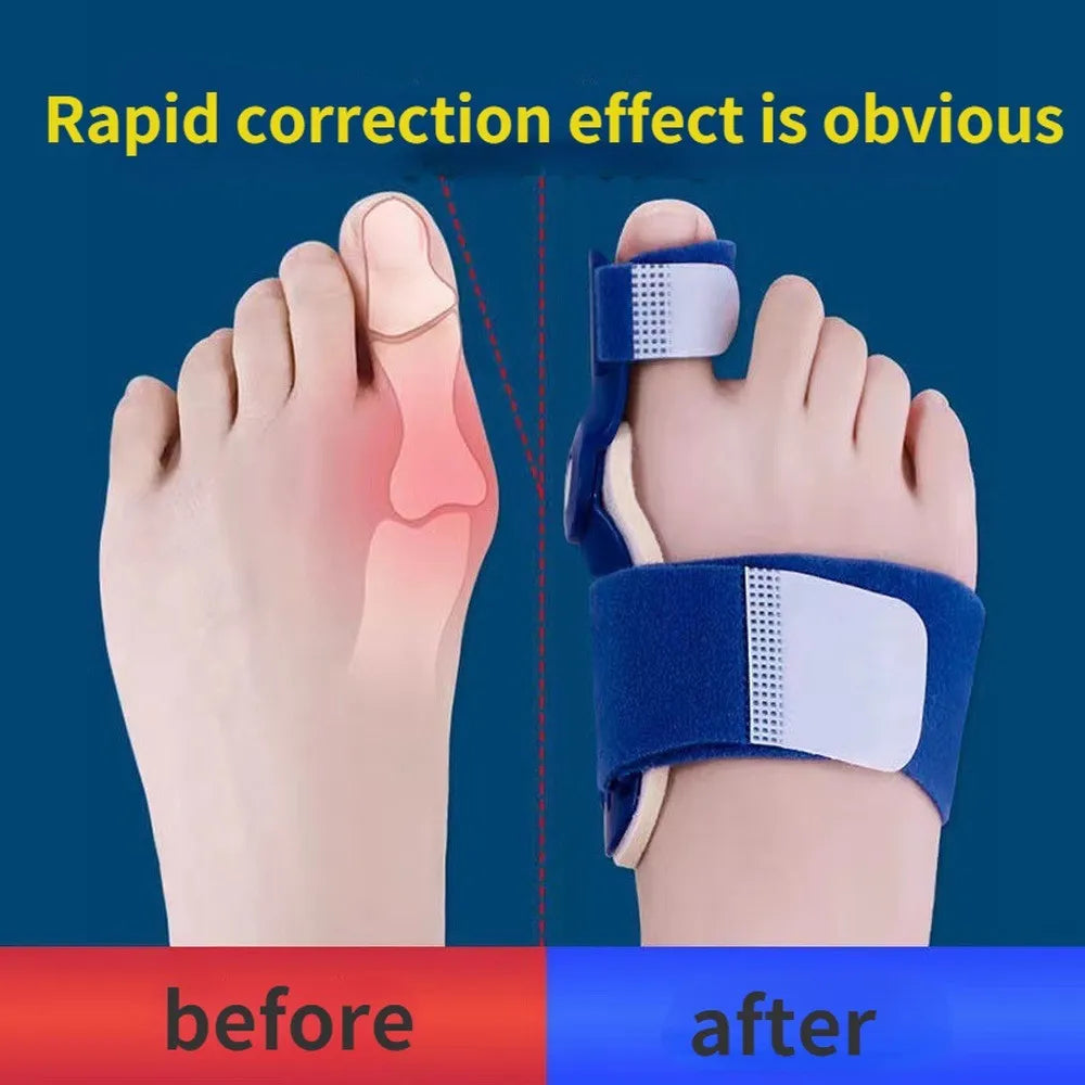 HalluxEase Verstellbare Hallux Valgus Schiene mit Zehentrenner und Fußgewölbestütze